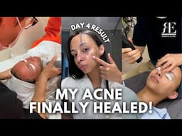 My Korean Acne Removal Journey 🇰🇷 | Microcell + Dermablate Results