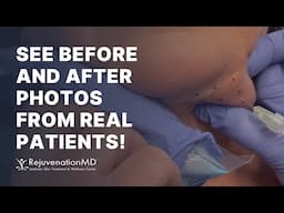 Sculpt Your Jawline with Kybella