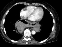 Gastric Adenocarcinoma