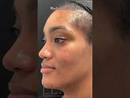 Black skin can safely and effectively be treated with laser
