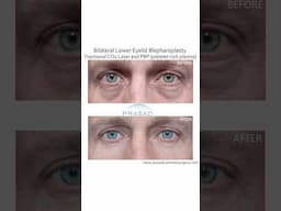 Treating Wrinkles and Dark Circles after Lower Blepharoplasty #wrinkles