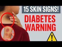Diabetes Alert 15 Unusual Skin Signs You Shouldn't Ignore