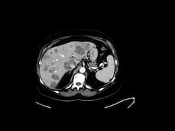 Metastatic gastric cancer