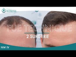 FRONTAL AND CROWN HAIR TRANSPLANT FUE TECHNIQUE GRAFTS 4818 (11085 HAIRS)