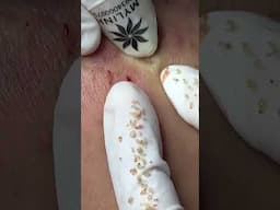 Linh My Dang Acne - 19/03/2025 part 1