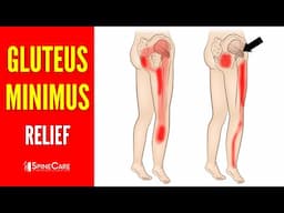 How to INSTANTLY Relieve Gluteus Minimus Pain