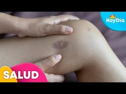 ¿La aparición de moretones sin golpes o equimosis es motivo de preocupación? | Hoy Día | Telemundo