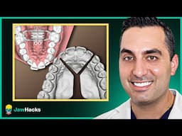 MARPE vs. Segmental LeFort: Which is Right for You?