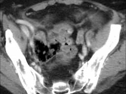 Rectal perforation