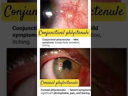 PHLYCTENULAR CONJUNCTIVITIS