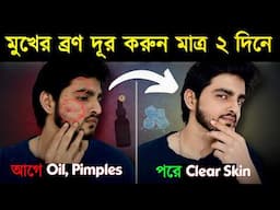মুখের ব্রণ দূর করার সহজতম উপায় (100%) | How to Remove Facial Pimples Naturally Without Wasting Money
