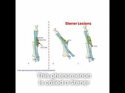 “Skier’s thumb” can cause a Stener lesion or painful and unstable thumb with reduced..