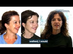 Bimaxillary Surgery Case #162: Isabel- Class II, Maxillo-mandibular retrusion, Gummy smile