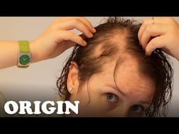 How To Cope With Female Hair Loss | Remedy Me