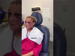 1 day after Facelift with Dr. Dilip D. Madnani