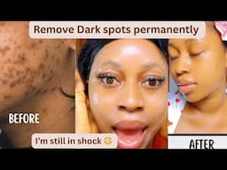 In 5 days Remove stubborn DARK SPOTS,ACNE SCARS & TEXTURED SKIN