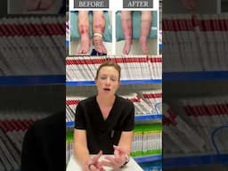 From living with PAD & chronic venous insufficiency, to walking toward healing! #PAD #painrelief