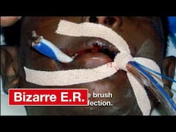 How Surgeons Removed An Impaled Toothbrush From A Boy - Bizarre ER