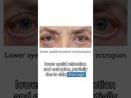 Why the Most Common Eye Bag Surgery Technique is Prone to Complications #eyebags