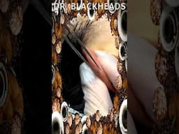 Blackheads Removal | Acne Treatment and Very Satisfying Satisfying Pimple pop #blackheads