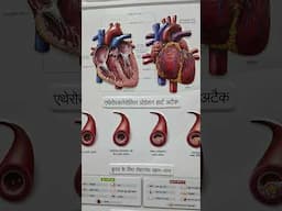 heart blockage #health #heart