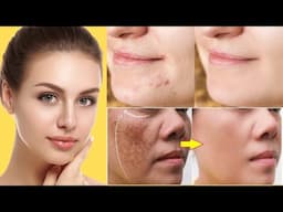 secret cure for freckles, hyperpigmentation, melasma & dark spots here's the 100% solution!!