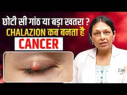 Chalazion (पलकों की गांठ) कब बनता है Cancer?