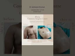 Gynecomastia Before and After.. Best results by Dr Ashwani Kumar