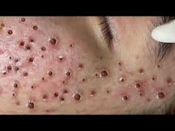 Loan Nguyen Acne Treatment 66x