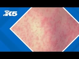 W.H.O. puts out measles warning
