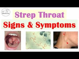 Strep Throat (Streptococcal Pharyngitis) Signs & Symptoms | CENTOR Criteria