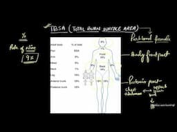 TBSA, Parkland formula for calculating fluid requirements in burns patient, Total burn surface area