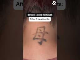 Removery = Not a typo 😅 #removery #tattooremoval