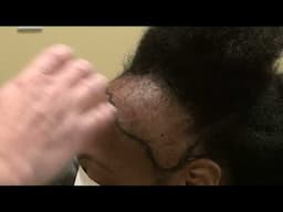 African Woman Flies from England for Curly Hair Transplant Restoration