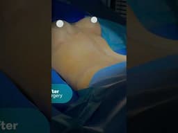 Live from the Operating Room: 360 FDL tummy tuck combined with a breast lift with implants 🎥
