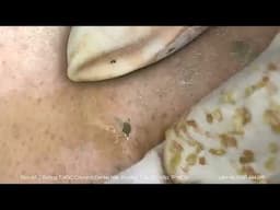 Big Cystic Acne Blackheads Extraction Blackheads & Milia, Whiteheads Removal Pimple Popping