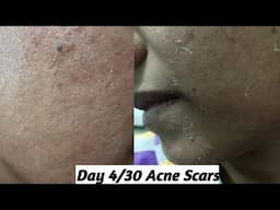 Day 4/30 Acne Scars #acnescars #scars #एक्नेस्कार्स