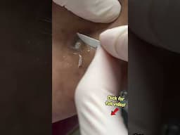 Glass in Foot Leads to Massive Corn Removal! | Podiatry ASMR