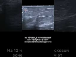 #узи #узимолочныхжелез