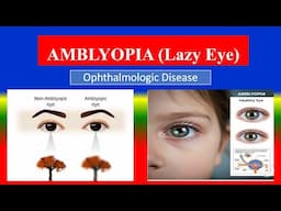 AMBLYOPIA (Lazy Eye) - Definition, types, causes, pathophysiology, symptoms , diagnoses , medicine