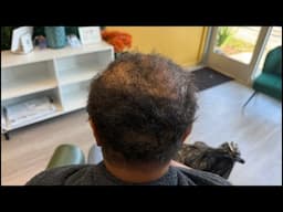 Alopecia Restoration | Work with me live!