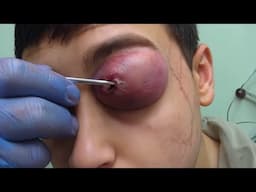 he got hit by a lightning..