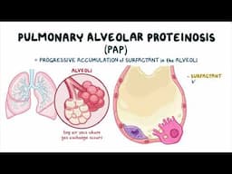 Understanding Pulmonary Alveolar Proteinosis (PAP): Symptoms and Treatment