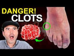 DON'T DIE from BLOOD CLOTS! Complete Guide to PREVENT Deep Vein Thrombosis