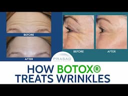 How Botox Treats Wrinkles