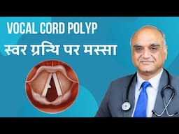Vocal cord polyp । स्वर ग्रंथि पर मस्सा। Dr Rajive Bhatia । Hindi