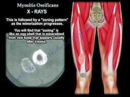 Myositis Ossificans: Causes, Diagnosis, Imaging, and Treatment