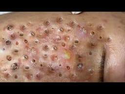 Loan Nguyen Acne Treatment 65x