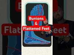 How Bunions Cause Flat Feet
