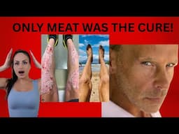 🔴 Severe PSORIASIS, ARTHRITIS, DEPRESSION, cured 100% on the CARNIVORE DIET after 30 years of pain!